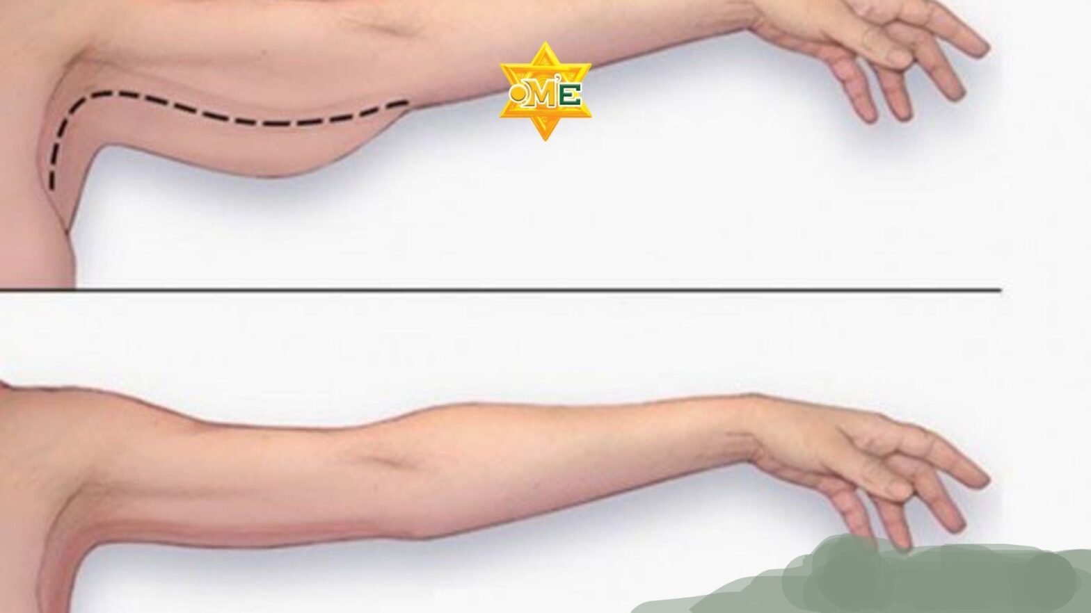 Cách thon gọn cánh tay hiệu quả tại nhà