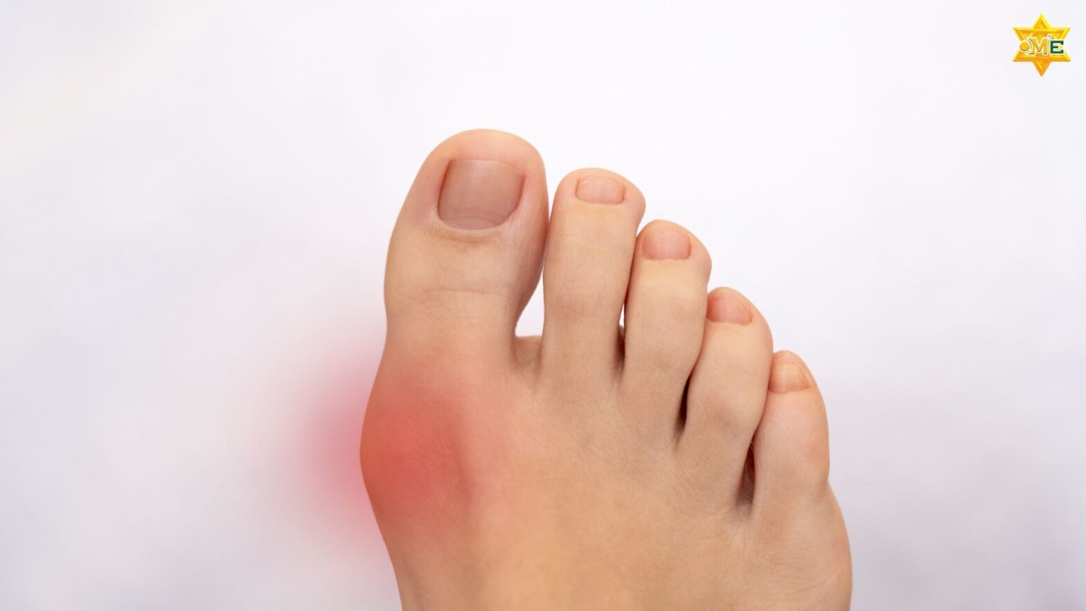 Bệnh Gút gây sưng đau khớp ngón chân cái