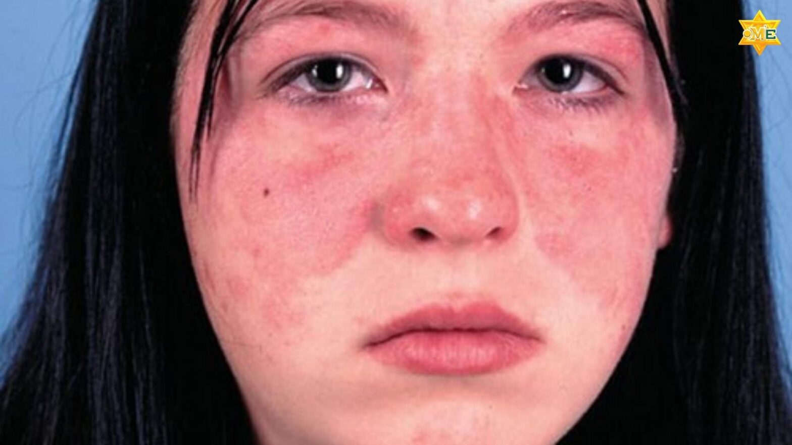 Dấu hiệu đặc trưng của lupus ban đỏ là phát ban hình cánh bướm xuất hiện đối xứng trên má và sống mũi