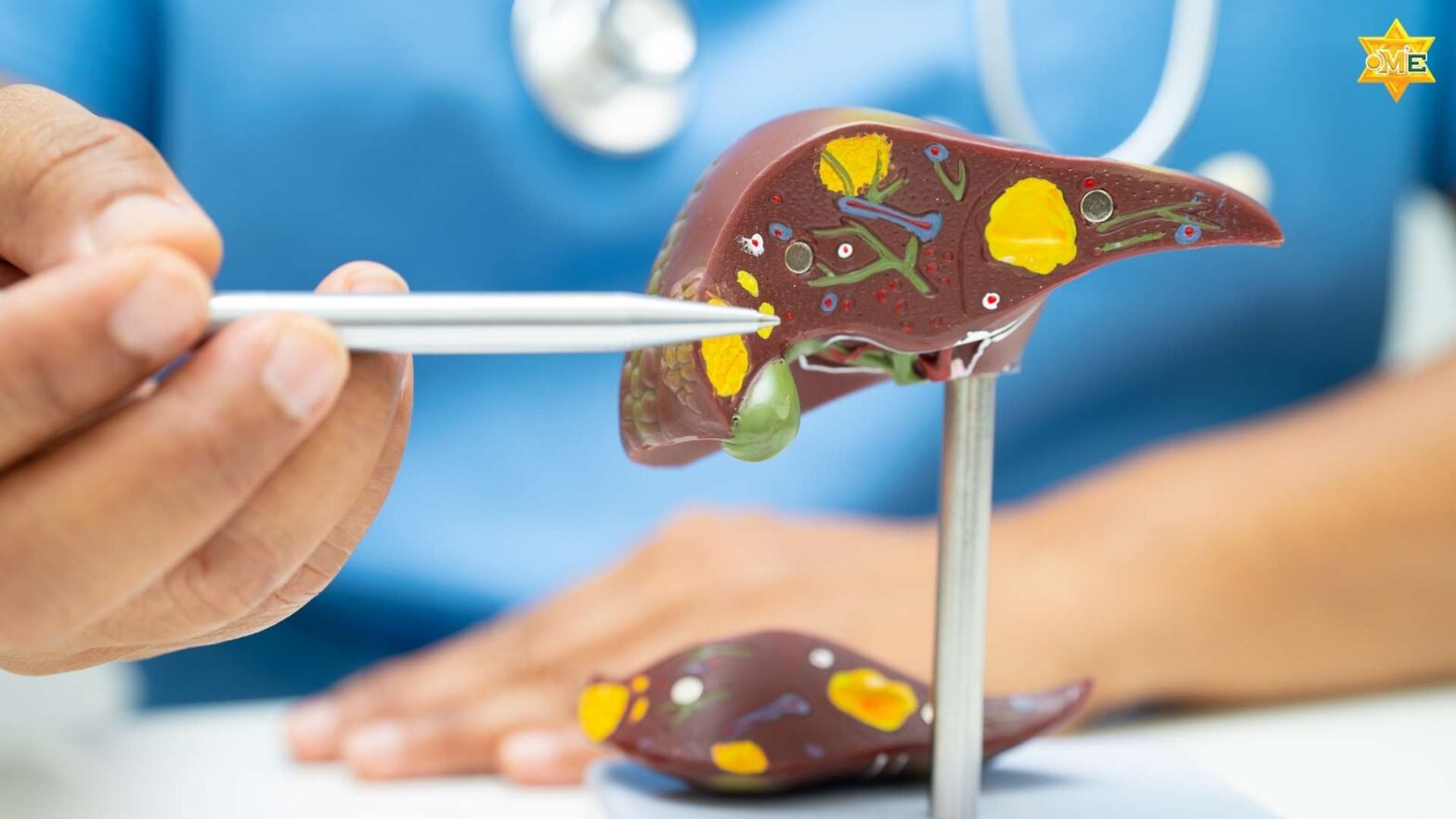 Hình ảnh minh họa gan người với khối u ung thư gan nổi bật