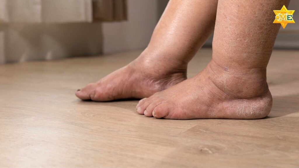 Triệu chứng phù nề vùng mắt và chân ở người mắc hội chứng thận hư