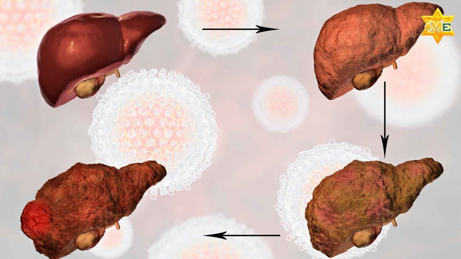 Hình ảnh minh họa xơ gan là gì và tổn thương gan