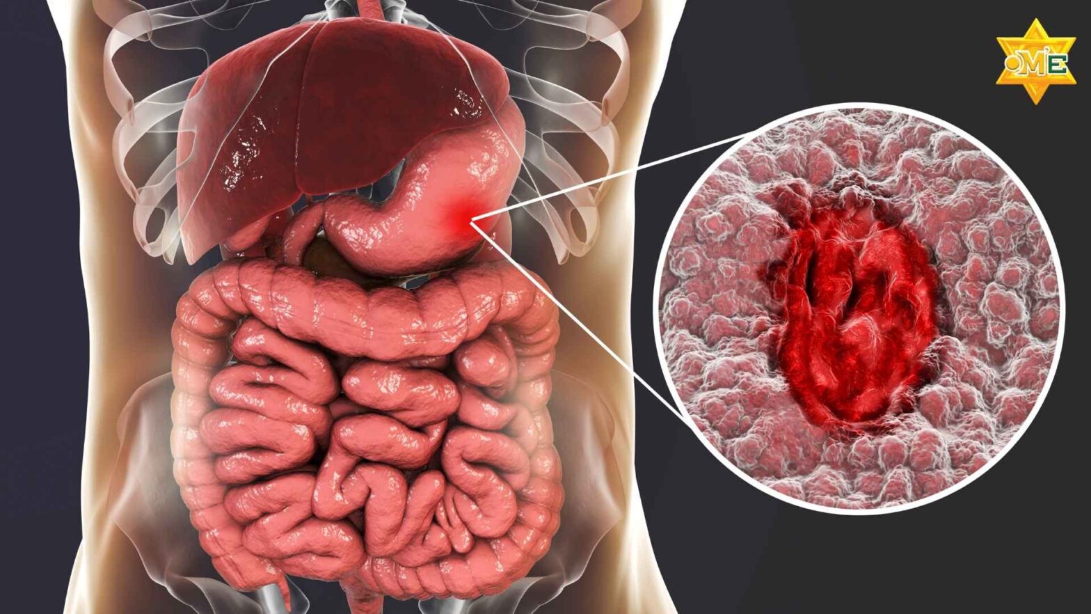 Hình minh họa cấu trúc dạ dày và vị trí đau dạ dày