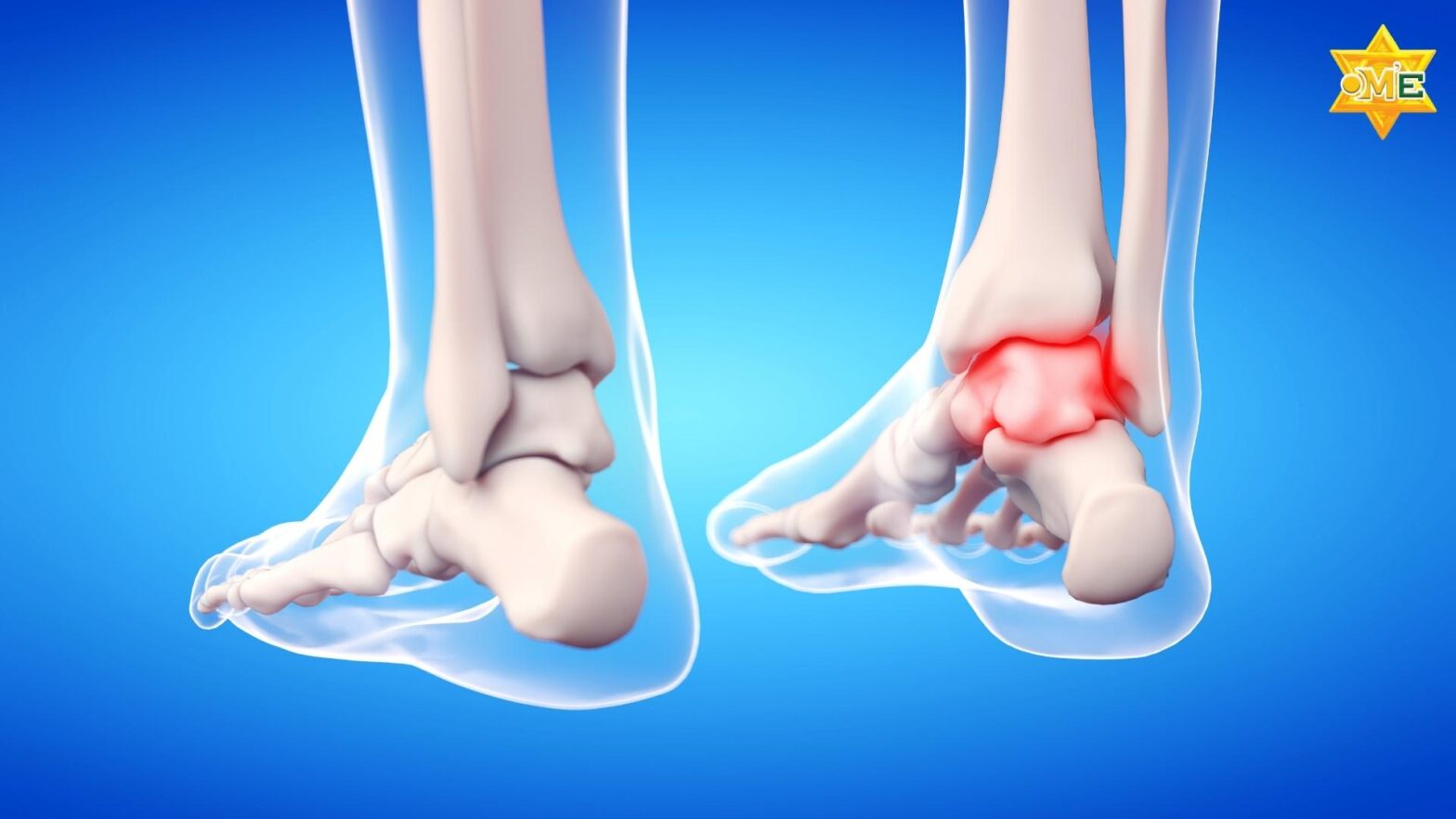 hiểu đúng về tăng axit uric và bệnh Gout