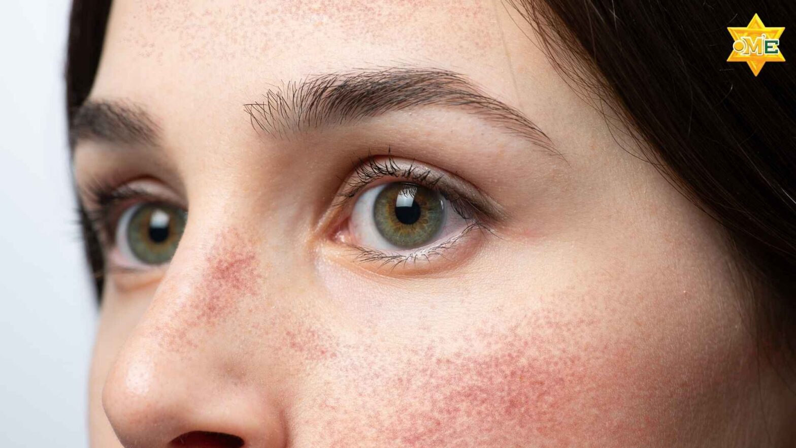 Triệu chứng đặc trưng của lupus ban đỏ