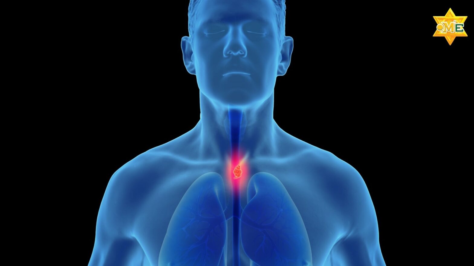 Hình ảnh minh họa ung thư thực quản là gì và tác động đến dinh dưỡng người bệnh