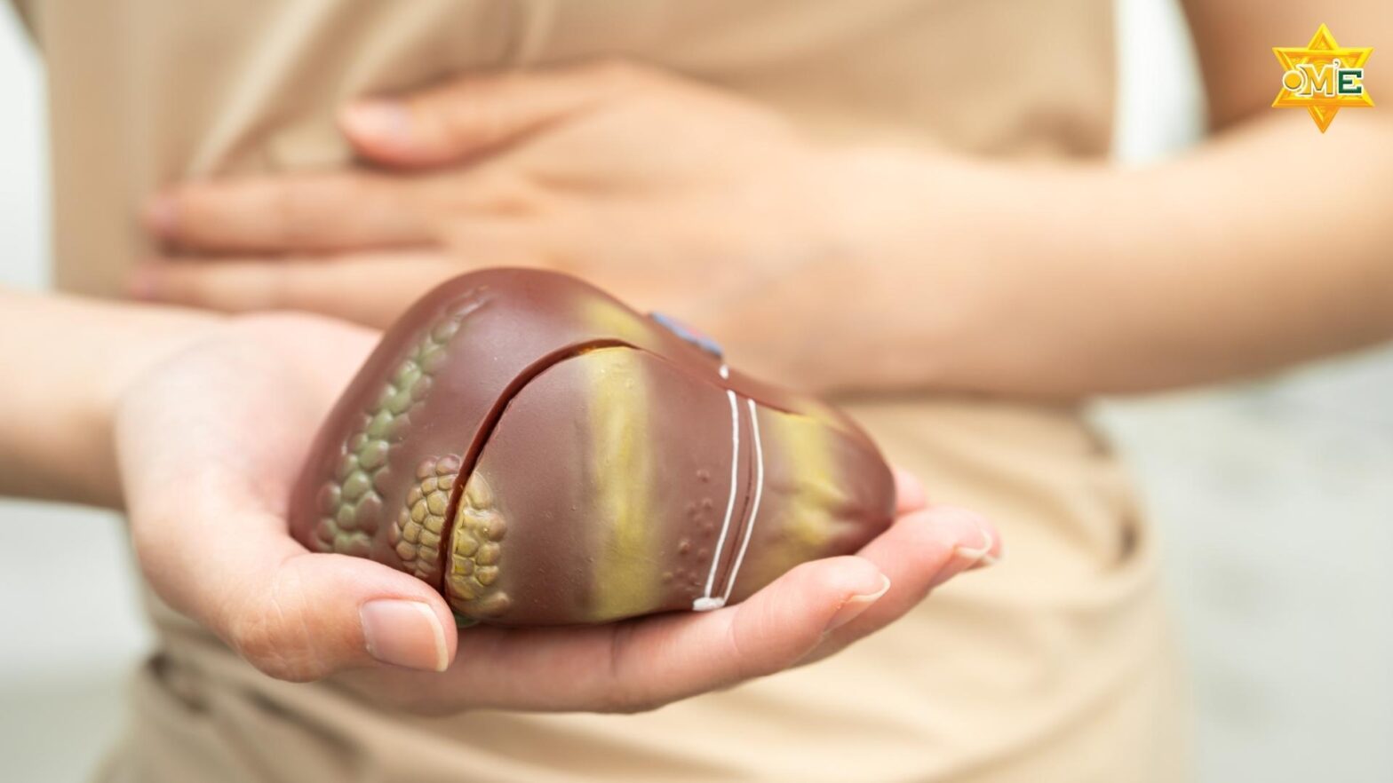 Người xơ gan cần chế độ ăn khoa học để bảo vệ gan và phòng biến chứng