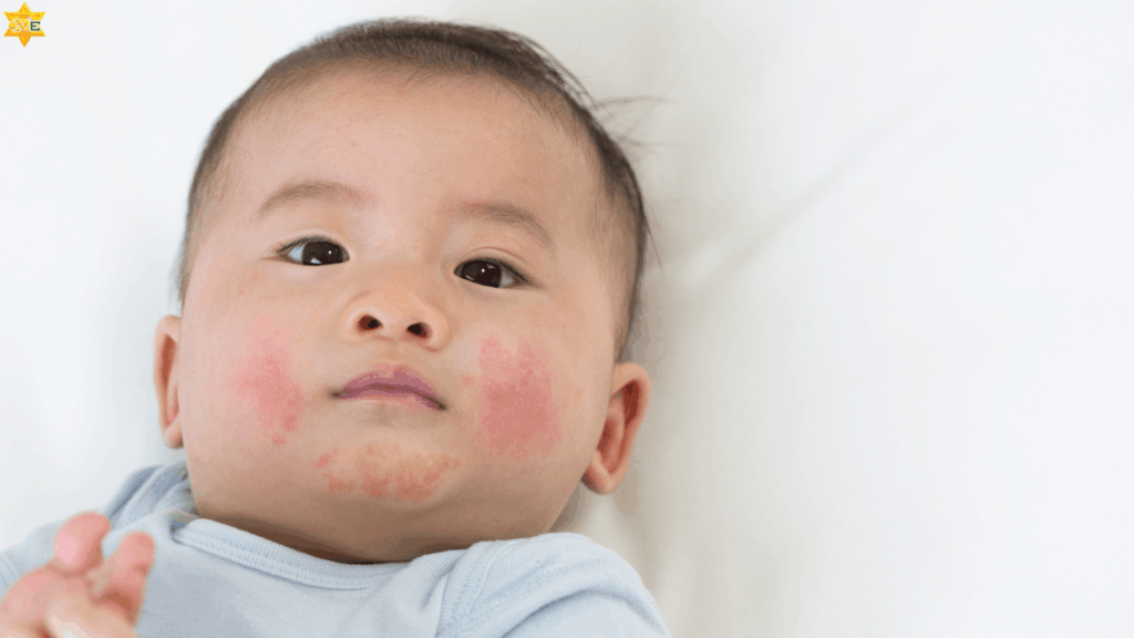 Nếu mụn kê kèm theo sưng đỏ, chảy mủ, bé sốt hoặc quấy khóc nhiều