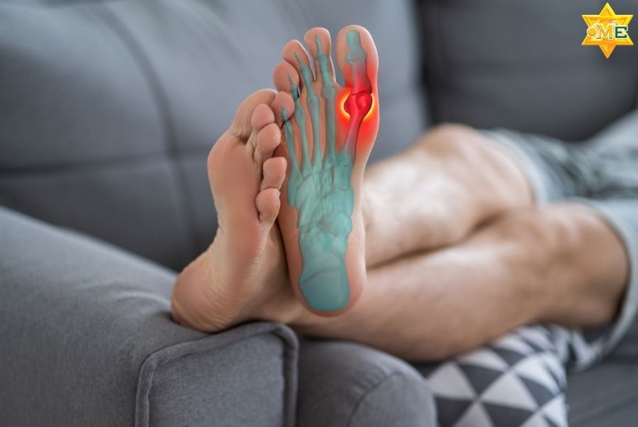 Bệnh gout có chữa được không