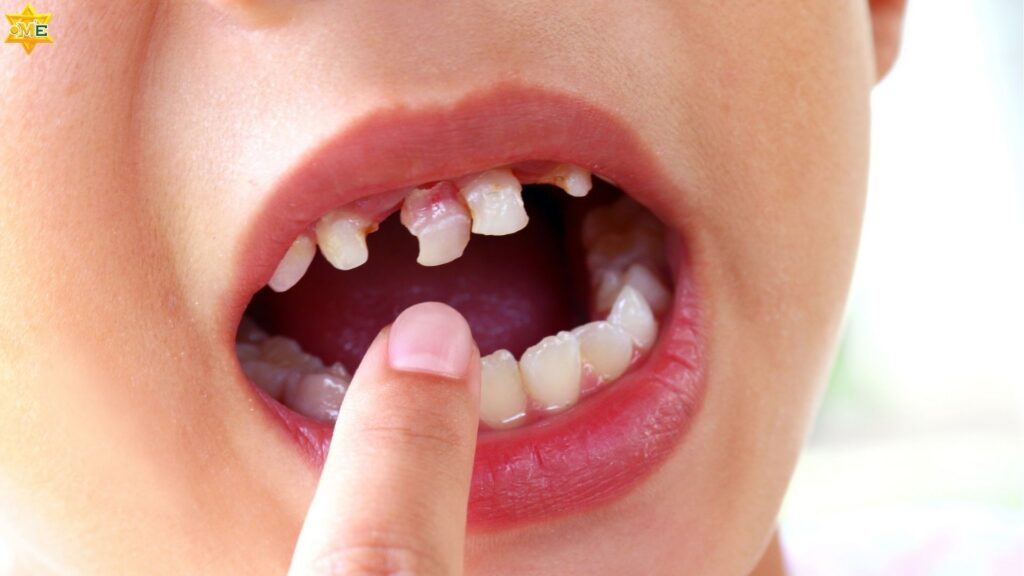 Sâu răng ở trẻ là vấn đề thường gặp ở trẻ